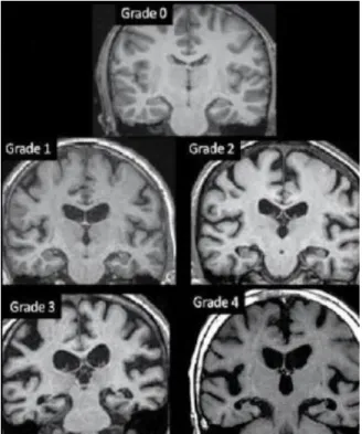 Figure 7 : Echelle de Scheltens : Grade de l'atrophie du lobe temporal interne 