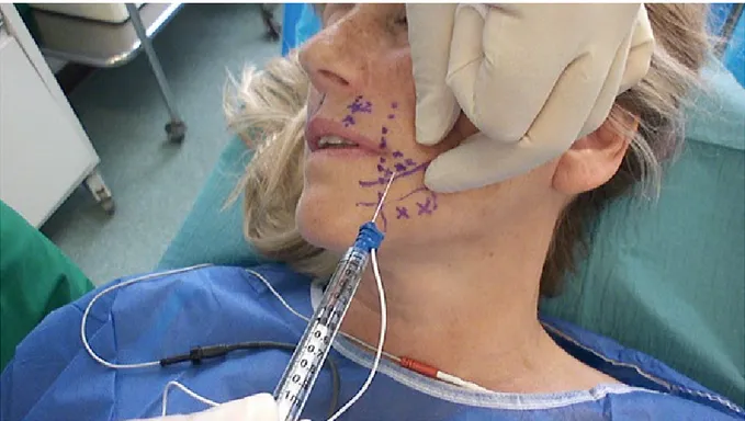 Figure 3 : Seringue vissée sur l’électrode aiguille introduite dans le muscle DAO  gauche