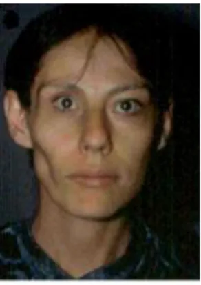 Figure  3 :  Femme  de  35  ans,  SPR  type  2  coté  droit  au  niveau  temporal,  zygomatique,  et  mentonnier
