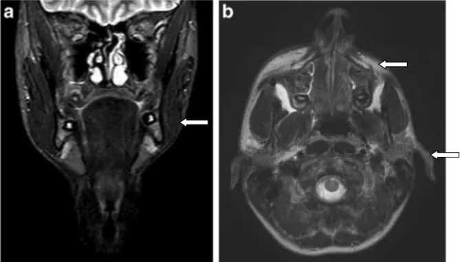 Figure 11 : utilisation de l’IRM dans le diagnostic et suivi du syndrome de Parry-Romberg