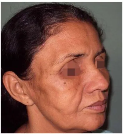 Figure  14 :  Femme  atteinte  d’un  Syndrome  de  Barraquer-Simons.  Lipo-atrophie  faciale  bilatérale rendant  saillante les cavités orbitaires dans ce cas