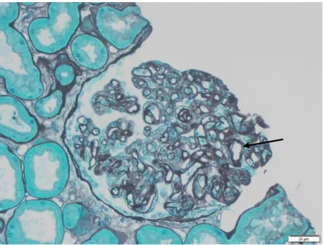 Figure 7 : Lésions de glomérulopathie du transplant (→) (cg3) chez un patient atteint d’un ABMR  chronique actif