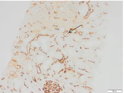 Figure 8 : Marquage C4d3 en immuno-histochimie ( →)  au niveau des capillaires péritubulaires chez une  patiente atteinte d’un ABMR aigu
