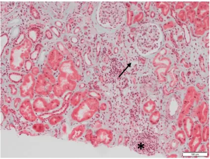 Figure 10 : Fibrose interstitielle (→)  et atrophie tubulaire de grade III. Inflammation dans la zone de  fibrose (*) Photographie réalisée au laboratoire d’anatomopathologie du CHU de Montpellier 