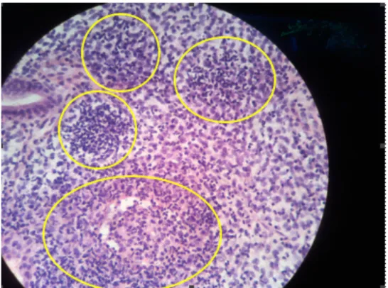 Figure 3 : Lame en coloration HES d'endométrite chronique : présence de plasmocytes 