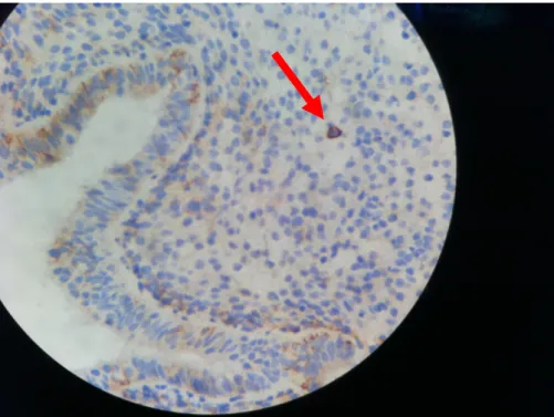Figure 4 : Lame d'endométrite chronique en immunomarquage : présence d'un plasmocyte  positif au CD138+