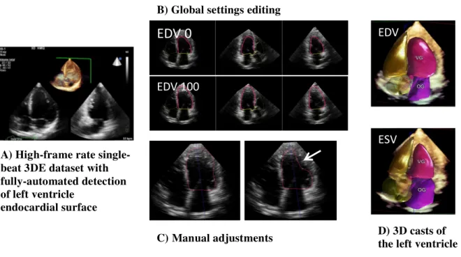 Figure  1:  Automated  3D  echocardiography  for  left  ventricular  quantification with HeartModel 