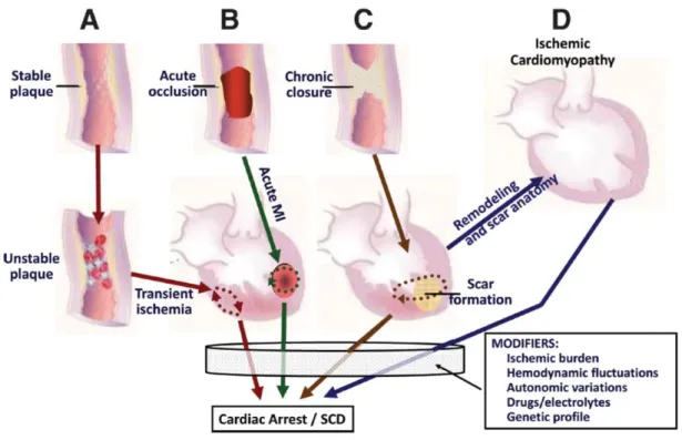 Figure 2 Mécanismes physiopathologiques à l’origine des arythmies ventriculaires menaçant  le pronostic vital dans la cardiopathie ischémique qui incluent (A) l’ischémie transitoire ; (B)  l’occlusion  aiguë ;  (C)  une  cicatrice  d’infarctus ;  (D)  la  