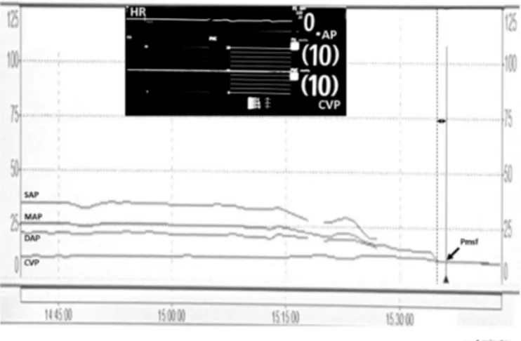 Fig.  1.  Illustration  of  measurement  of  1-min  mean  systemic  filling  pressure  (Pmsf)  in  a  patient  who  died  with  central  venous  and  arterial  catheters