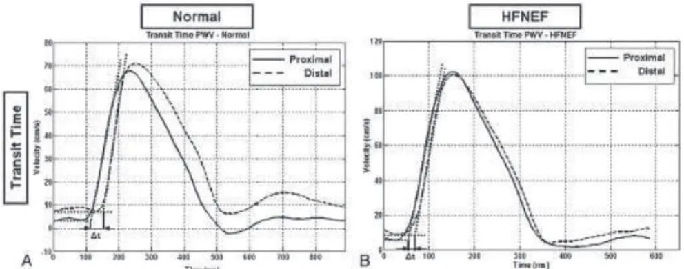 Figure 6: Vitesse de londe pouls aortique normale (A) et accélérée chez les patients porteur dICFEP (B)