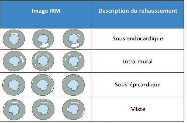 Figure 9: illustration des 4 localisations possibles de rehaussement selon 3 exemples 