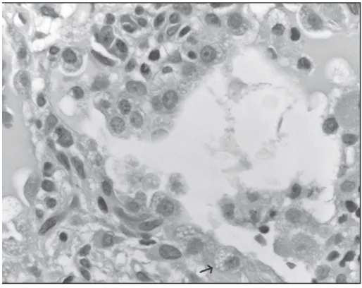 Figure 3 : Image en microscopie optique d’une alvéole retrouvant une inflation du tissu interstitiel et une  hyperplasie des cellules pulmonaires de type II