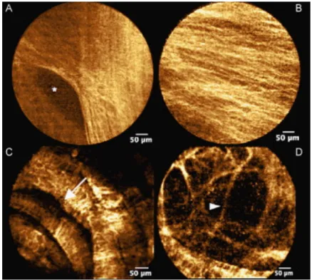 Figure 6 : Aspects d’une imagerie bronchique normale en MCFF montrant le réseau élastique de la membrane basale et la  microstructure des bronchioles distales