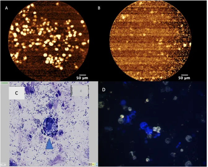 Figure 9 : Les images  A et B sont les images observé en MCFF ex vivo sur le LBA. Les images C et D sont des  exemples de cytologie d’un LBA adressé d’un centre extérieur