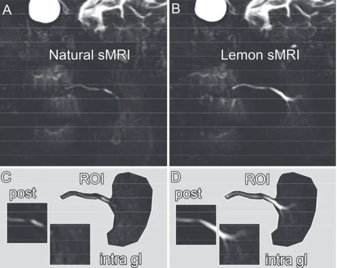Figure 1: Normal parotid gland sMR pattern: Natural sMR vs Lemon  sMR comparison 