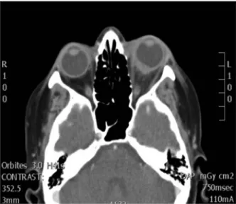Figure 2. Scanner orbitaire : épaississement  scléral. 