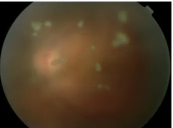 Figure 3: Uvéite postérieure :  choriorétinopathie de  Birdshot avec nombreux granulomes choroïdiens  jaunâtres prédominant en nasal inférieur de la papille