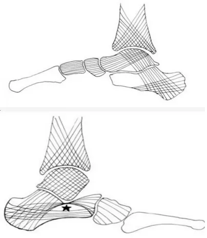 Figure 2 : Représentations des travées osseuses sur une coupe sagittale de l’arche interne (en haut)  et  de l’arche externe (en bas)