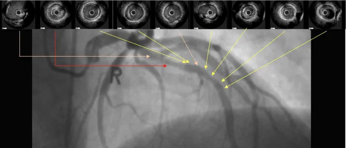 Figure 3 : IVUS de l’IVA 