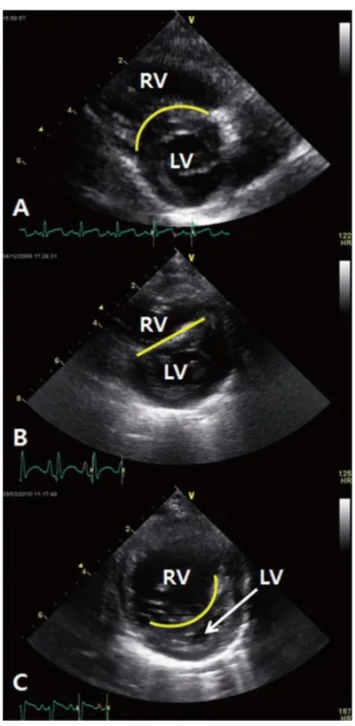 Figure 3 : aspect du SIV à l’échographie cardiaque.  A : SIV de type 1 bombant dans le ventricule droit (RV)