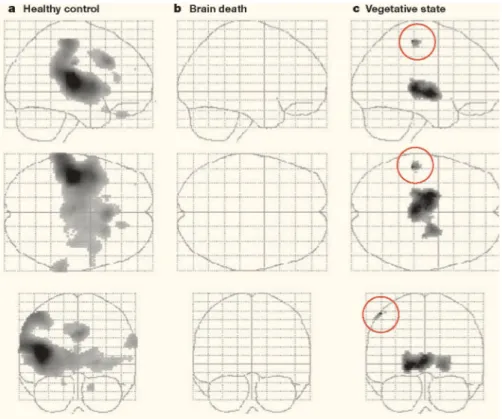 Figure   3.  Cortical   activity   in   response   to   painful   stimuli   in   heathly   controls   and   in patients with brain death or in a vegetative state