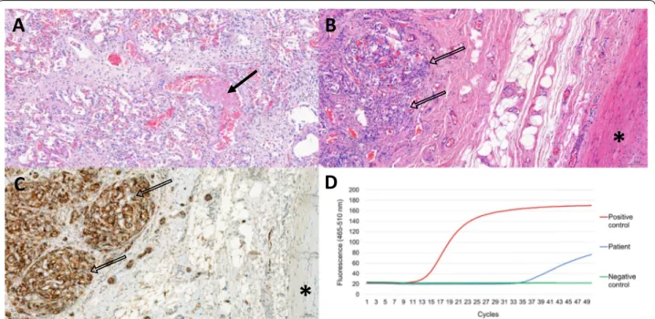 Fig. 1  A Post-mortem tissue specimen showing a diffuse alveolar damage and a partially occluded microvascular structure in the lung (arrow)  (hematoxylin eosin; × 100); B lobules of the left carotid body (open arrows) separated by thin connective tissue s