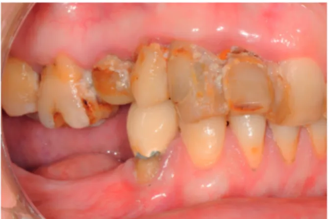 Figure 2 . Patient édenté partiel (moyenne : 10 dents) .