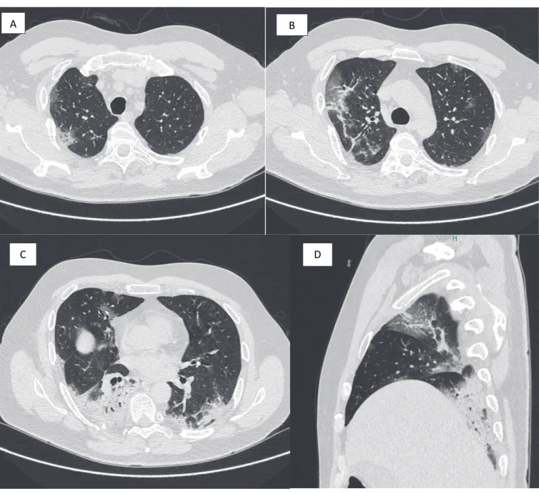 Figure 1  : Images scannographiques d’une pneumopathie à COVID-19 