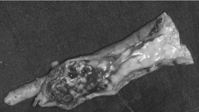 Fig. 2 : Séquestres athéromasiques de bifurcation carotidienne pré- pré-levés en bloc et montrant sur la face interne un caractère irrégulier, et majoritairement thrombotique du matériel exposé au flux à  desti-née cérébrale.