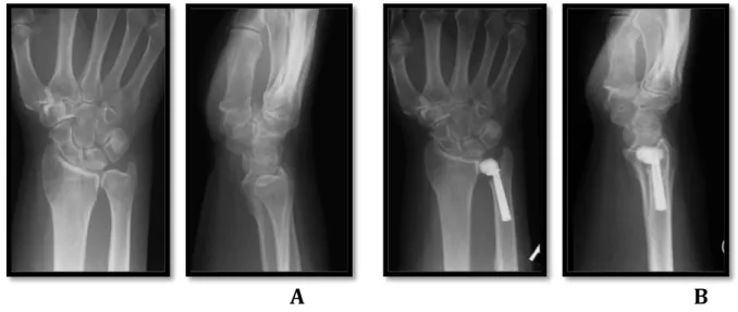 Figure  33.  A  80­year­old  woman  with  painfull  DRUJ  arthrosis  and  scaphotrapezometacarpal  arthrosis. 