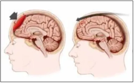 Figure  1.  Mécanisme  à  l’origine  de  commotion  cérébrale :  coup  direct  ou  whiplash,  Integretive functional medecine 