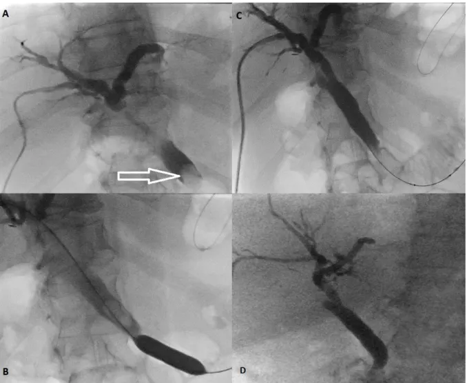 Figure  3.  Percutaneous  transhepatic  cholangiography  procedure.  A  =  Cholangiography  showing common bile duct stone (white arrow)