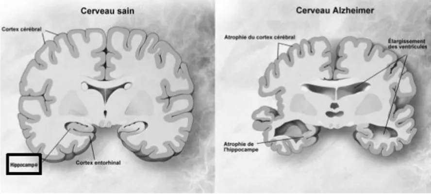 Figure 1 : Comparaison entre un cerveau sain et un cerveau Alzheimer 