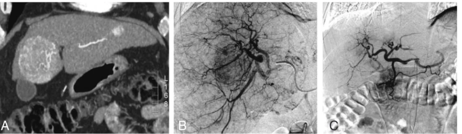 Fig. 1. — A: Coronal Multi-Planar Reconstruction (MPR) of a contrast enhanced CT scan of arterial phase demonstrates a hyper - -enhancing  lesion  in  segment  IV