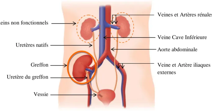 Figure 1 – Schéma du rein greffé chez un patient en insuffisance rénale [2] 