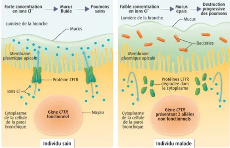 Figure 3: Schéma de la physiopathologie de la mucoviscidose [9] 