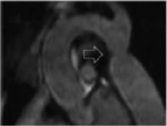 Figure  9.  Coarctation  aortique  dans  le  syndrome  de  Turner,  d’après  Mortensen  et  al.Endoc Review 2012 