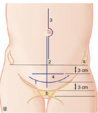 Figure  1  :  Différents  types  d'incision  cutanée  (Source  :  Encyclopédie  Médico-Chirurgicale  (9)) 