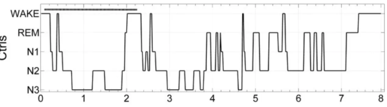 Figure 3. Hypnogram showing sleep cycles (Gemignani et al., 2012).  