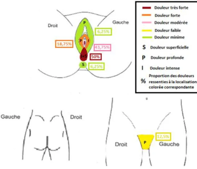 Figure 1 : Localisation des douleurs périnéales persistantes à 6-8 semaines du post- post-partum