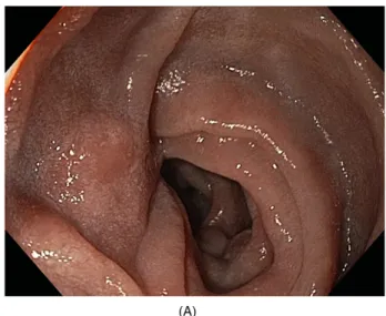 Figure 50.5 (A) Normal ileum: the mucosa is homogeneously pink and the villi are regular and well developed