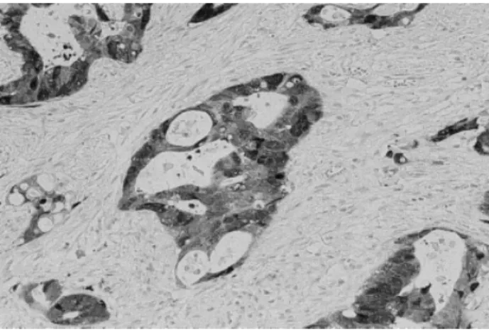 FIGURE 2. Islets of carcinomatous cells from a rectal carcinoma specimen treated preoperatively with radiotherapy showing cytoplasm and/or nuclear metallothionein immunoreactivity.