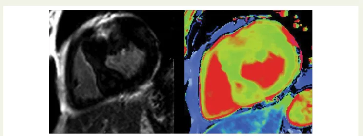 Figure 10 LGE and native T 1 map in a patient with HCM. The LGE image (left) shows enhancement in the anterior wall that is also seen on the T 1