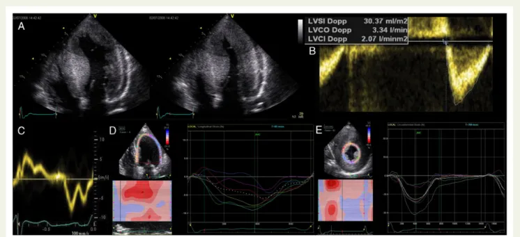 Figure 11 Typical echocardiographic systolic function findings in a patient with HCM. (A) Supernormal ejection fraction (72%)