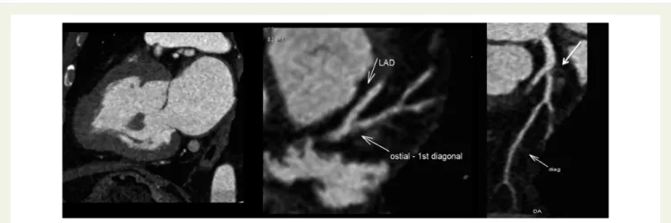 Figure 16 Non-invasive coronary angiography (CCT). Anatomical imaging of epicardial CAD in a 52-year-old patient with HCM and chest pain.