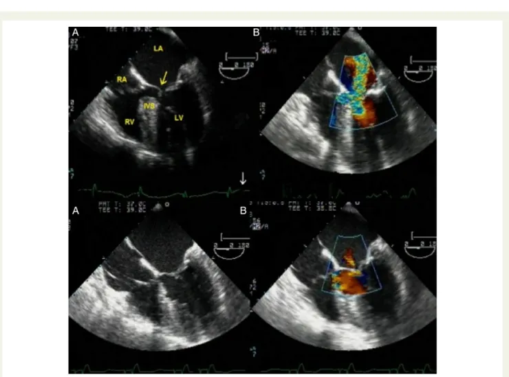 Figure 18 Surgical myectomy monitoring with intraoperative TOE, 08. Upper row—before surgery: IVS hypertrophy, mitral SAM (arrow) (left), colour aliasing in the site of obstruction (LVOT) and SAM-related MR (right)