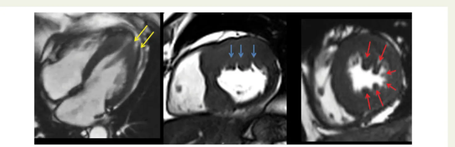 Figure 19 Cine CMR-SSFP four-chamber view—HCM patients with severe obstruction, NYHA class 3 despite maximal medical treatment