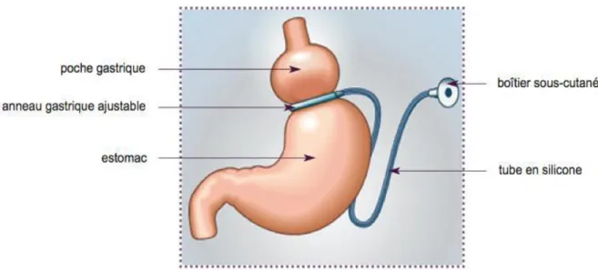 Figure 1 : Schéma d’un Anneau gastrique ajustable (AGA) [15]. 