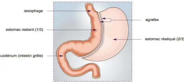 Figure 2 : Schéma d’une Sleeve gastrectomy [15]. 