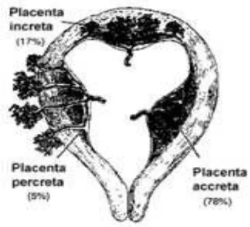 Figure 2. Placenta accreta, increta, percreta (11) 